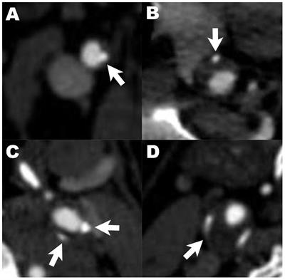 Carotid Atherosclerotic Calcification Characteristics Relate to Post-stroke Cognitive Impairment